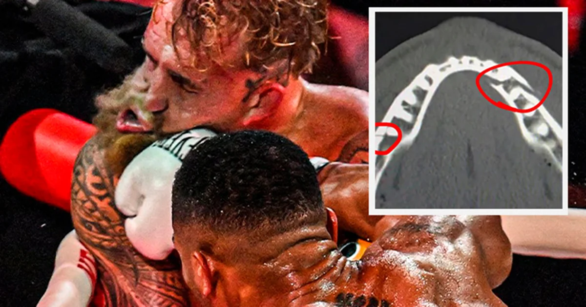 Paul posteó en su cuenta de Instagram una radiografía en la que se detalla la lesión