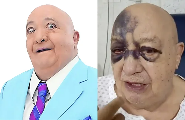 La esposa del comediante contó detalles del accidente que sufrió el famoso y mencionó que se encuentra hospitalizado.
