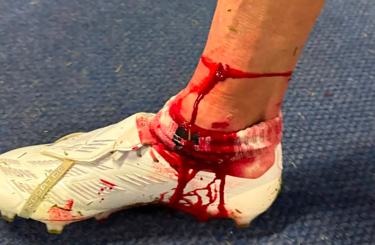 Así quedó el pie de Lucas Di Yorio tras el golpe ante Chicago
