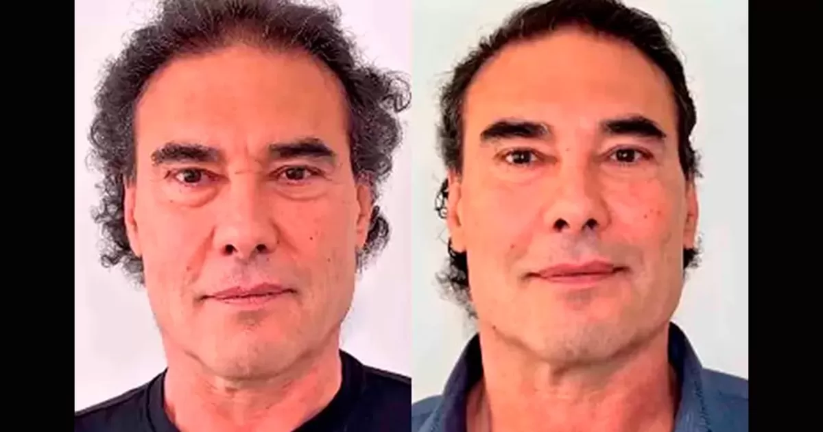 Eduardo Yáñez estrena nueva cara tras someterse a rejuvenecimiento facial