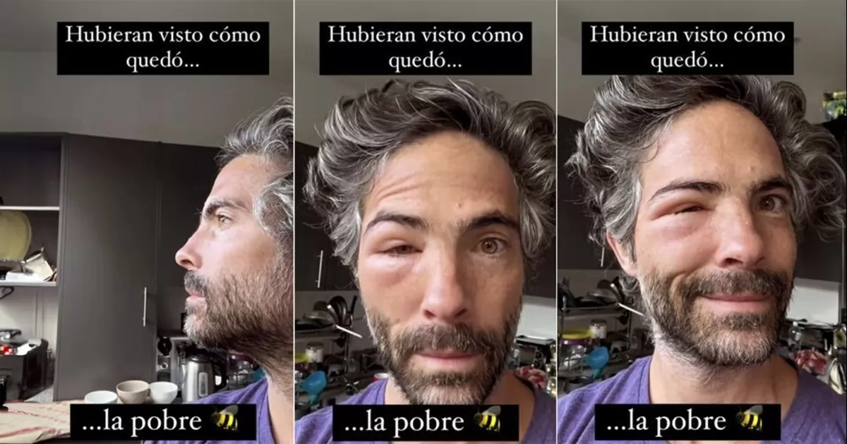 Osvaldo Benavides muestra como queda el rostro después de una picadura de abeja
