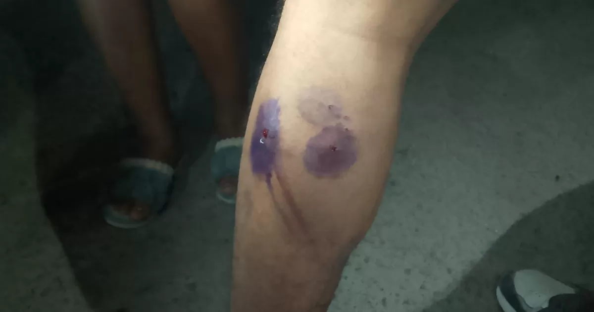 Perro ataca a joven y lo deja herido en fraccionamiento Ana de Torreón
